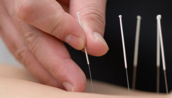 The doctor uses needles for treatment of the patient