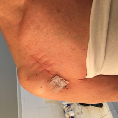 This is the scar from my shoulder replacement surgery, four weeks after the surgery.