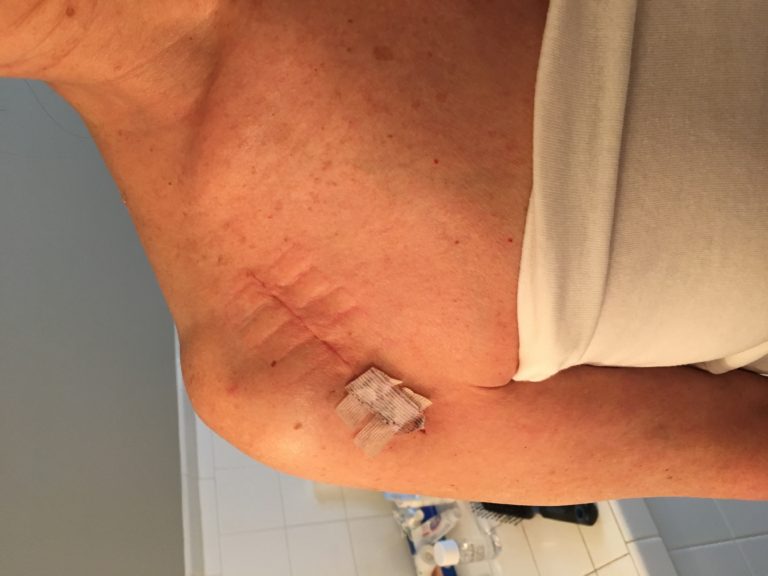 This is the scar from my shoulder replacement surgery, four weeks after the surgery.